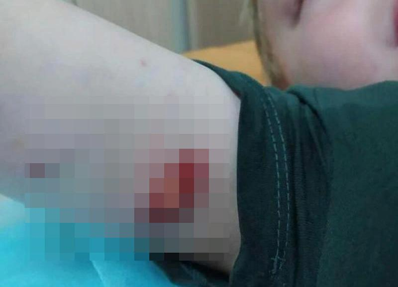 Агрессивная собака покусала пятилетнего ребенка на детской площадке в Михайловске Агрессивная собака покусала пятилетнего ребенка на детской площадке в Михайловске