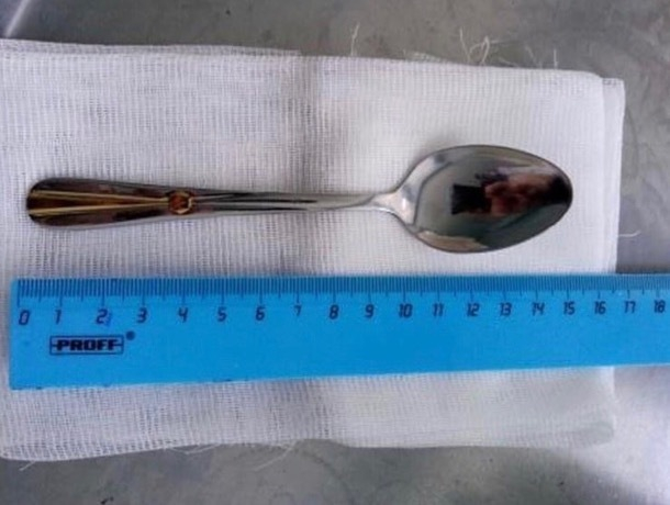 В Ставрополе врачи вытащили из желудка девочки 14-сантиметровую ложку